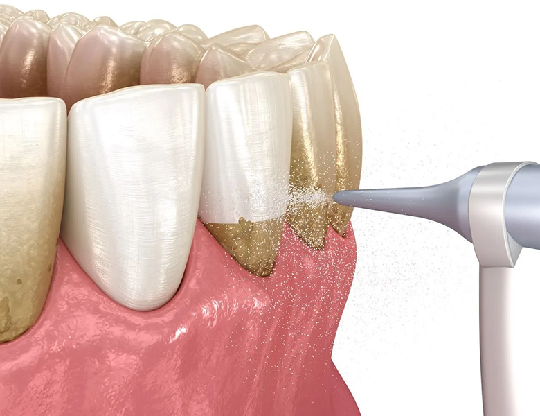 小竹向原・江古田の歯医者、村松歯科医院のGBTメンテナンス(Guided Biofilm Therapy)