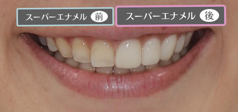 小竹向原・江古田の歯医者、村松歯科医院のスーパーエナメル