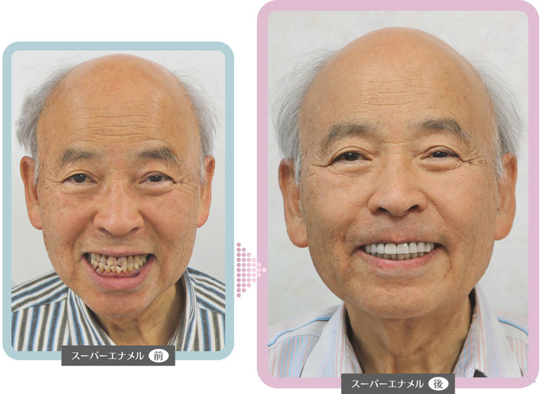 小竹向原・江古田の歯医者、村松歯科医院のスーパーエナメル