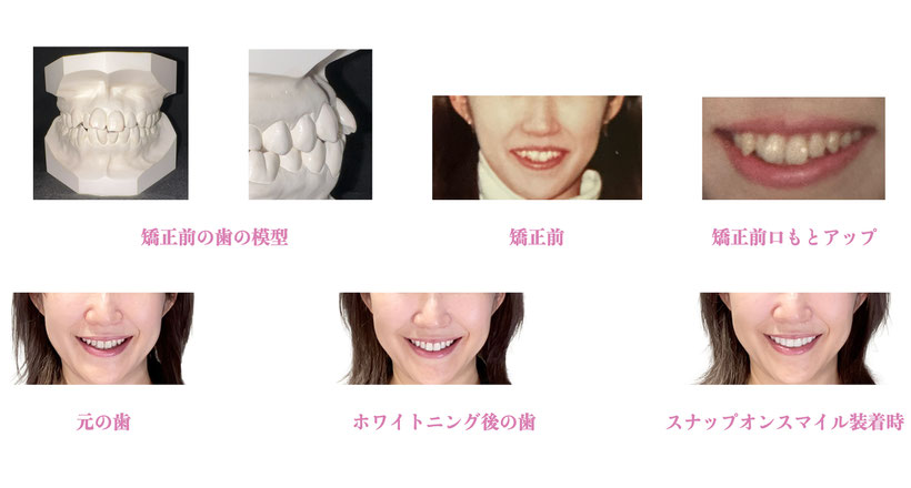 小竹向原・江古田の歯医者、村松歯科医院のスーパーエナメル