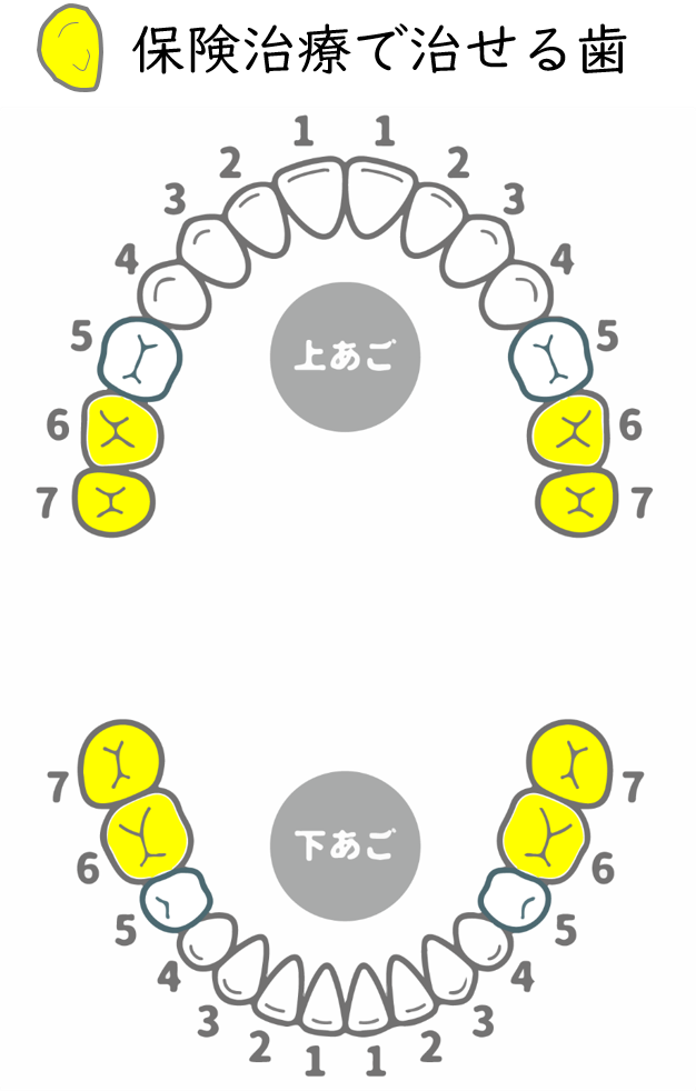 PEEK冠